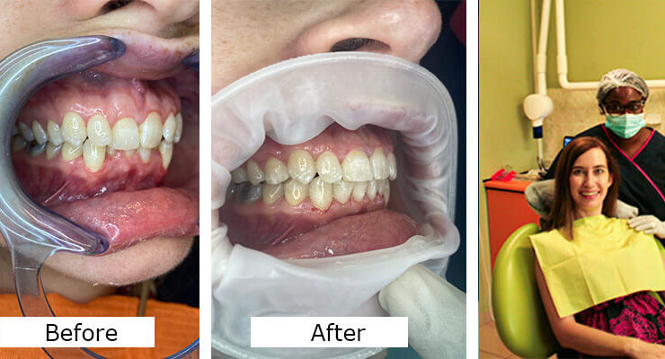 Orthodontic Treatment