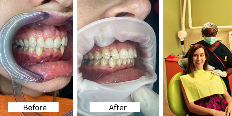 Orthodontic Treatment